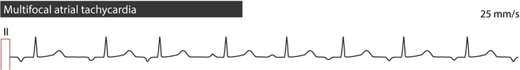 Figure 4. Multifocal atrial tachycardia