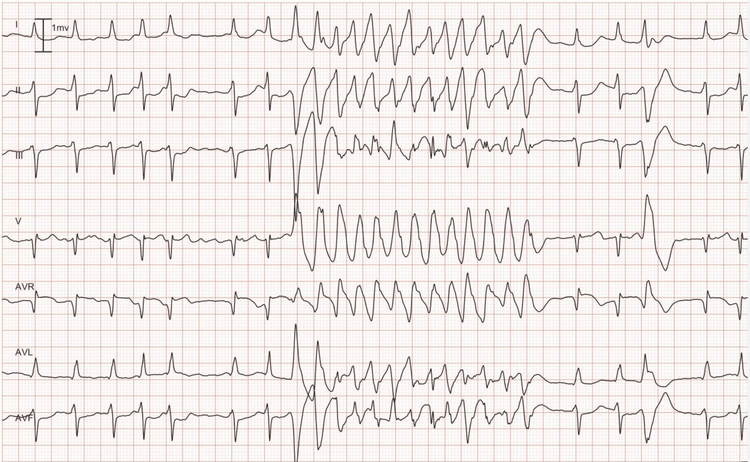 Figure 8. Lead I, II, III, V1 aVR, aVL and aVF. As seen in the beginning of the recording, the patient has an underlying rhythm of atrial fibrillation. The atrial fibrillation is interrupted by a rapid and regular tachycardia with wide QRS complex. Note the 4th beat from the end; it is a premature ventricular beat and its QRS morphology is identical to the QRS seen during the tachycardia. Hence, the tachycardia also originates from the ventricles, which implies that it is ventricular tachycardia (VT).