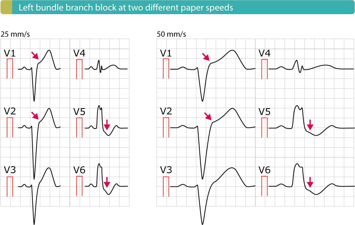 Illustration ur kursen Tests ECG (Quiz)