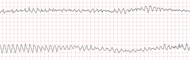 Dégénérescence du rythme cardiaque
